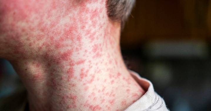 South Carolina Measles Outbreak Is 'Accelerating,' Driving Hundreds Into Quarantine