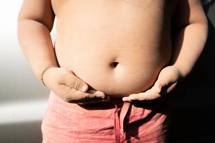 One Million More U.S. Kids Became Obese During COVID Pandemic