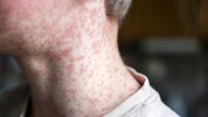 South Carolina measles outbreak ‘accelerating,' driving hundreds into quarantine