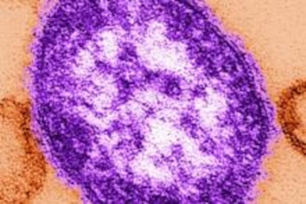 Measles exposure alert issued for flight from Toronto to Edmonton