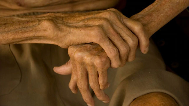 Leprosy persists in Chennai’s industrial & border pockets; study flags rising child cases