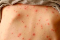 Estados Unidos: más de 250 personas en cuarentena por brote de sarampión