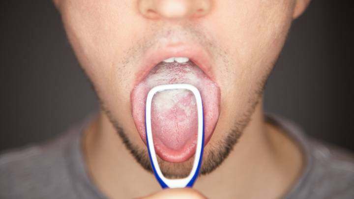 This is what happens when you do not clean your tongue for a month