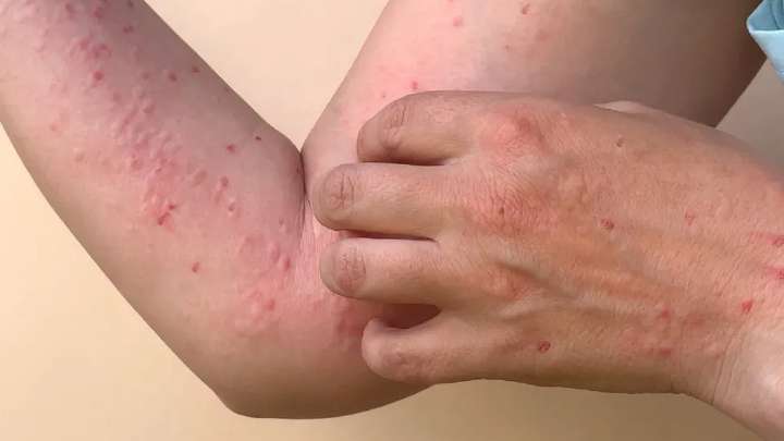 En Nuevo León, 2 de los 6 casos de viruela símica en México en la semana 47