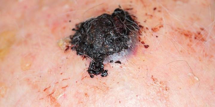 Menos es más para la inmunoterapia que combate el melanoma, argumenta un estudio