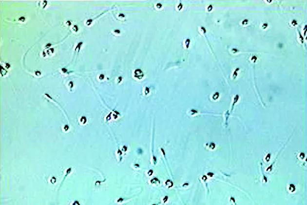 Un donante de esperma con una mutación genética vinculada al cáncer engendró casi 200 niños en Europa