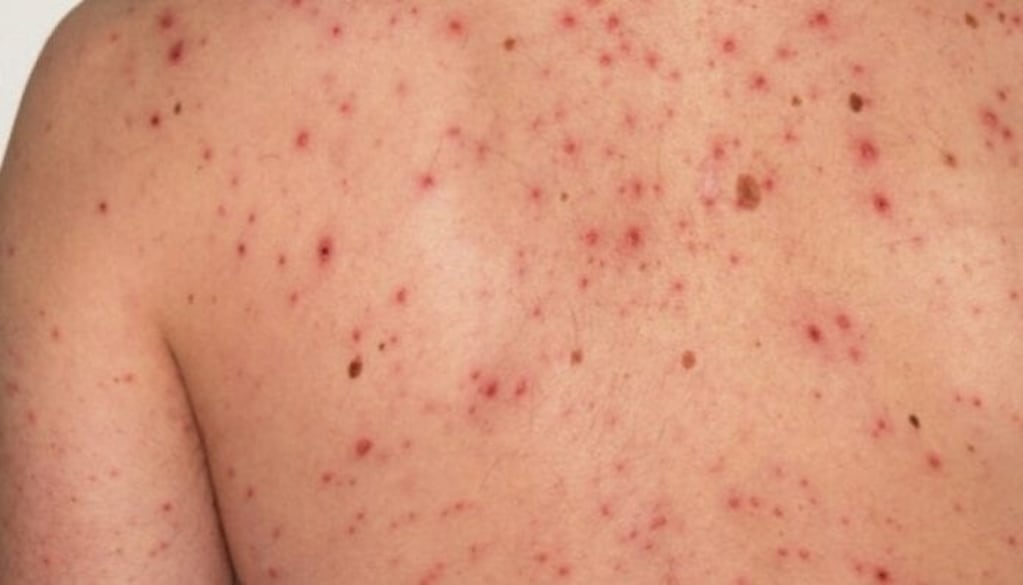 Chile emitió una alerta por brote de sarampión en Argentina