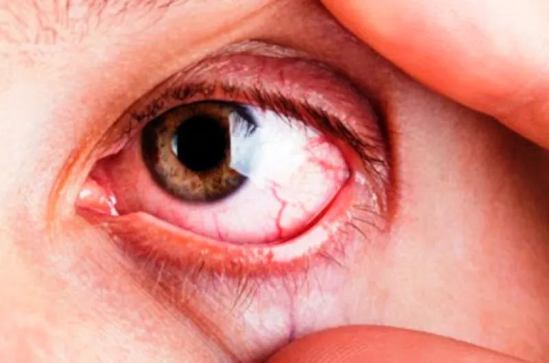 Las 4 enfermedades oculares frecuentes en la vejez: claves para detectarlas a tiempo y preservar la visión