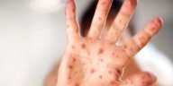 S.C. measles outbreak reaches 62 amid holiday period