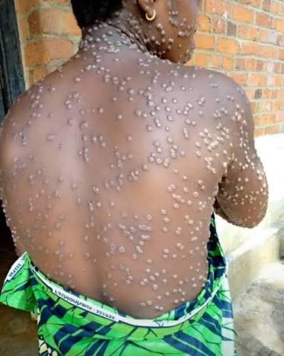 Malawi Registers New Mpox Case, Total Rises to 141 Since April