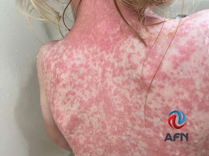 Alertan a personal médico por casos de sarampión en el Valle de Mexicali