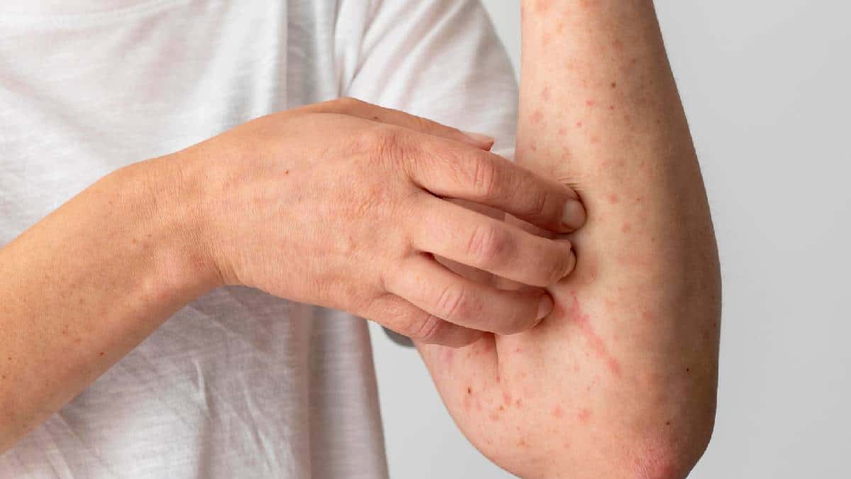 Descubren una nueva variante de la viruela del mono en Inglaterra