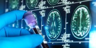Biomarcador Sanguíneo promete la detección del Alzheimer
