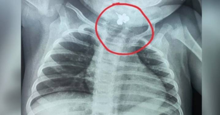 Cinco días con fiebre y sin comer: descubren que una bebé tenía un anillo atorado en la garganta