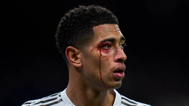 Jude Bellingham immediately booked despite suffering gruesome eye cut