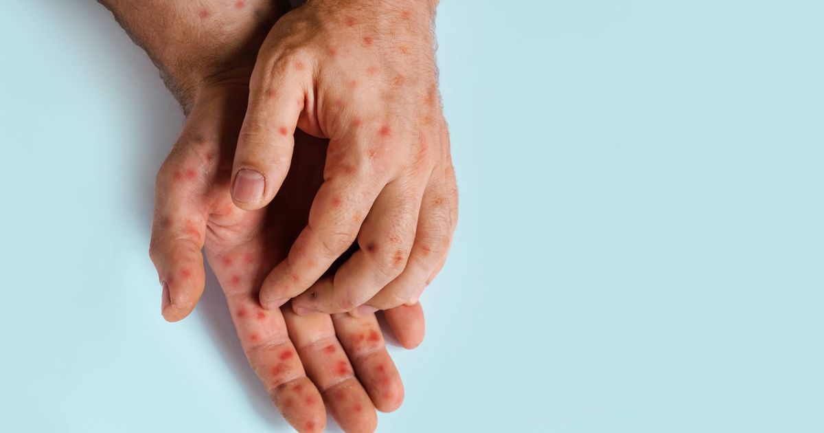 New mpox strain detected in UK is 'precisely what experts feared would happen'