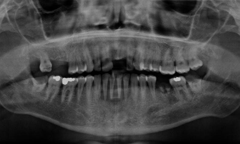 Not just a health crisis: How oral cancer is silently becoming an economic issue