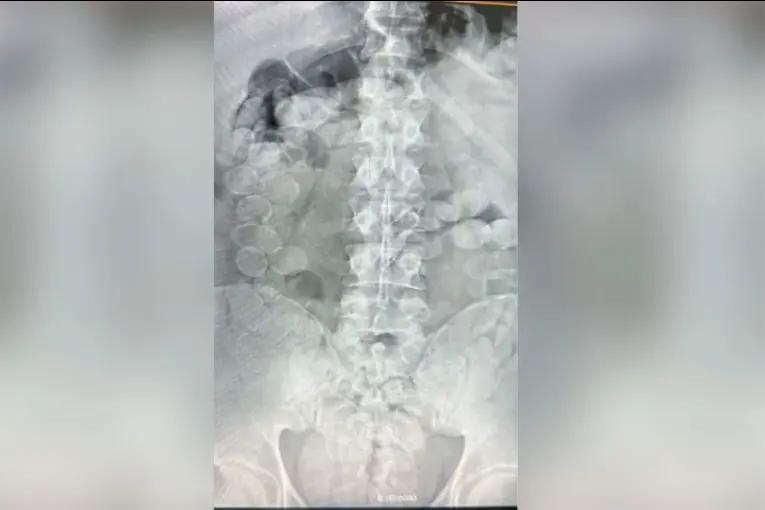 Detuvieron a dos pasajeros con 180 cápsulas de cocaína dentro de sus cuerpos