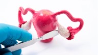 Miomas: la ablación y la radiofrecuencia supera el 80% de eficacia