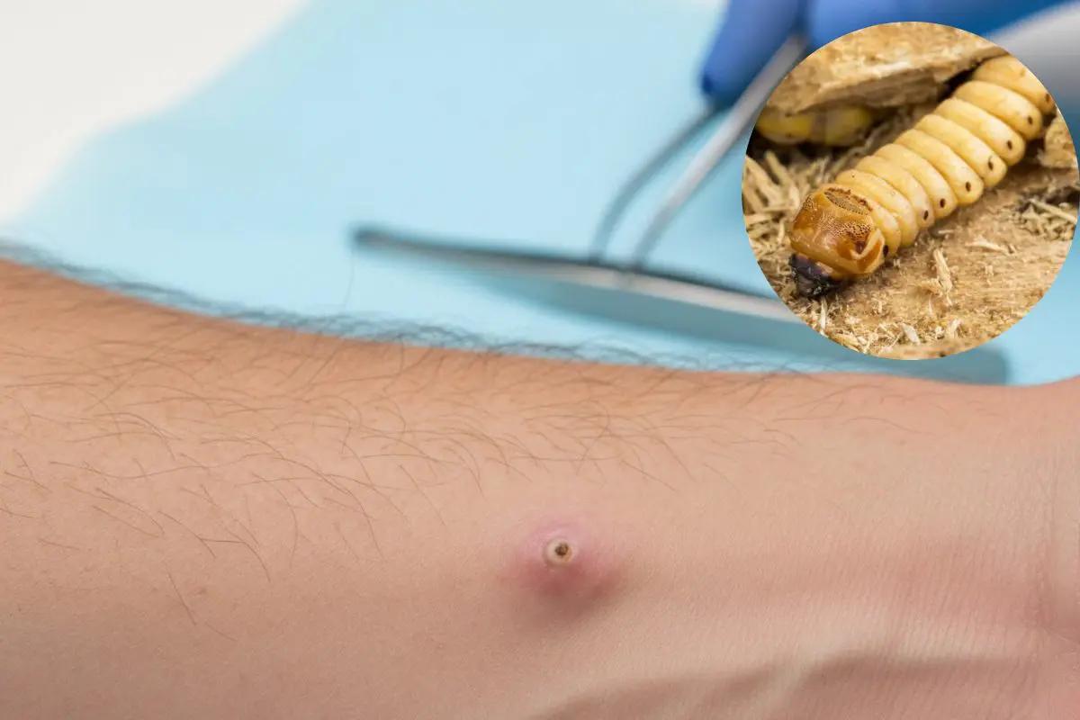 México registra 92 casos de infección por gusano barrenador en humanos