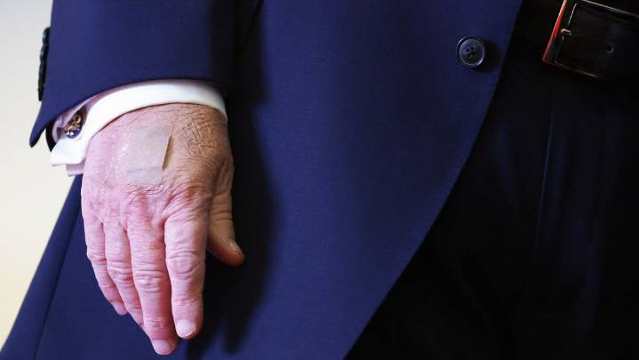 La curiosa explicación de la Casa Blanca para los extraños vendajes en la mano de Trump