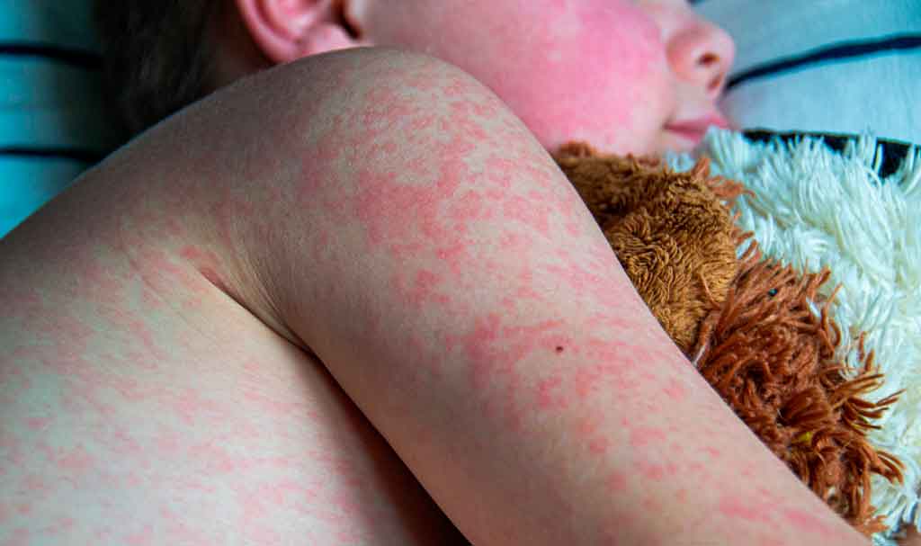 Insisten en Uruguay en la vacunación contra el sarampión