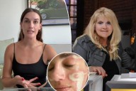 Celebrity esthetician sued for $71K after client says she was left burned, scarred