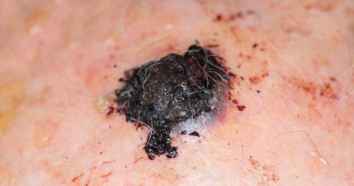 Less Is More For Melanoma-Fighting Immunotherapy, Study Argues