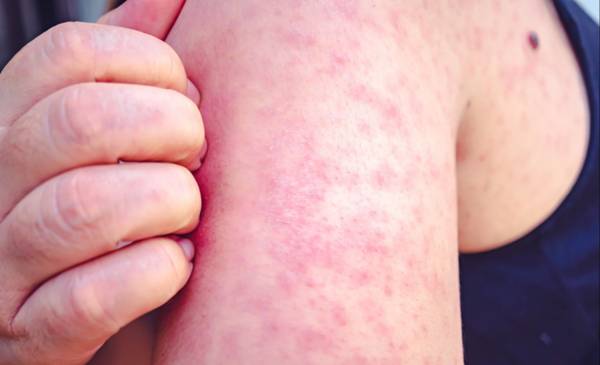 Estados Unidos: más de 250 personas quedaron en cuarentena por brote de sarampión en Carolina del Sur