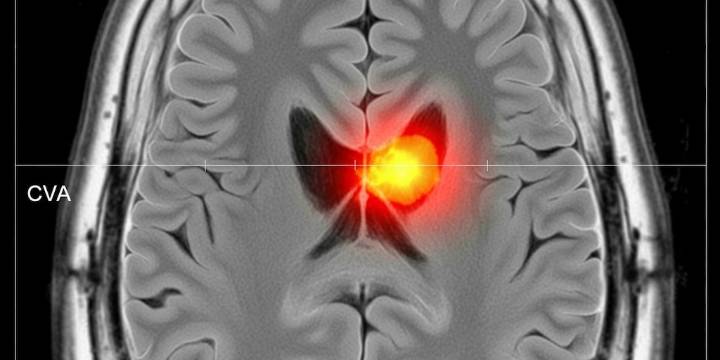 Los cinco síntomas que podrían indicar un ACV y nunca deben subestimarse, según un neurólogo