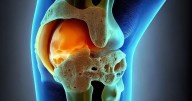 Fewer Opioids Needed After "Needle" Knee Surgery