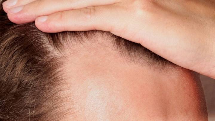 New Baldness Drug Boosted Hair Growth by 539% in Trials