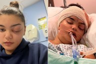 Teen's Sniffles Led to Her Eye Popping Out "Like a Golf Ball'