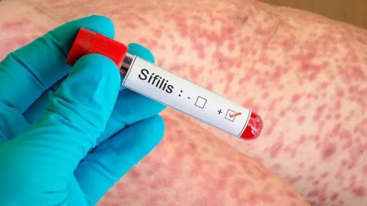 Los casos de sífilis crecieron 38% en un año en Mendoza