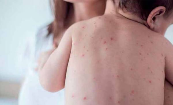 El Ministerio de Salud detectó un caso de sarampión en Entre Ríos y reactivó la alerta a nivel nacional