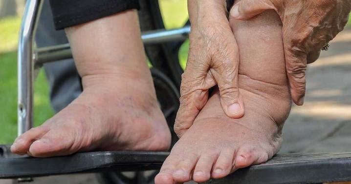 Common Painkillers Trick Doctors Into Misdiagnosing Heart Failure, Study Warns