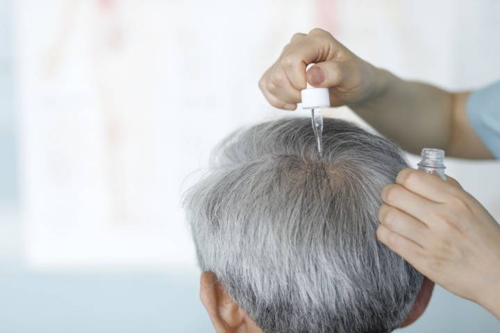 Procapil vs. Minoxidil: Which Is Better for Hair Loss?