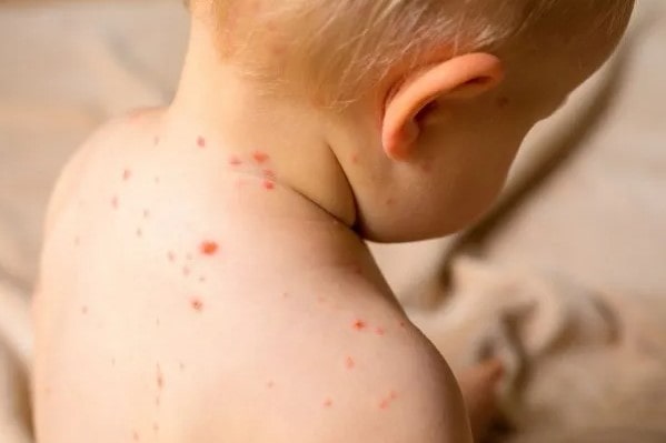 El Ministerio de Salud detectó un caso de sarampión en Entre Ríos y activó una alerta nacional