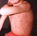 Detectaron un nuevo caso de sarampión en Entre Ríos y se reactivó la alerta a nivel nacional