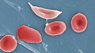 Fulcrum sickle cell pill data at ASH: Higher dose works better