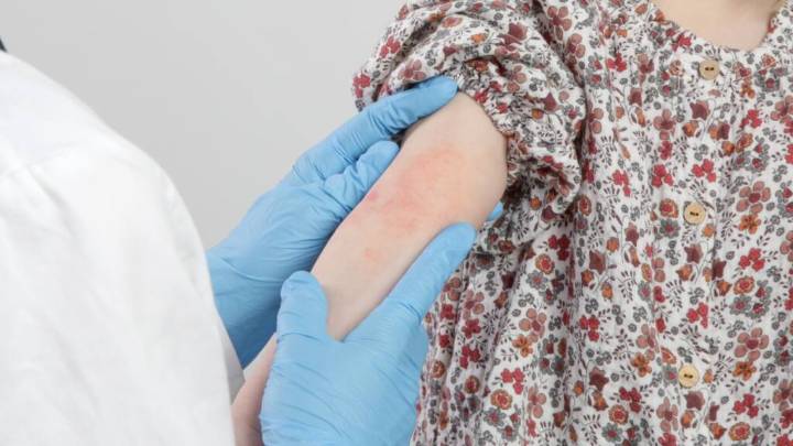 Gobierno emite una alerta epidemiológica por baja vacunación contra el sarampión en Argentina y el alza de casos