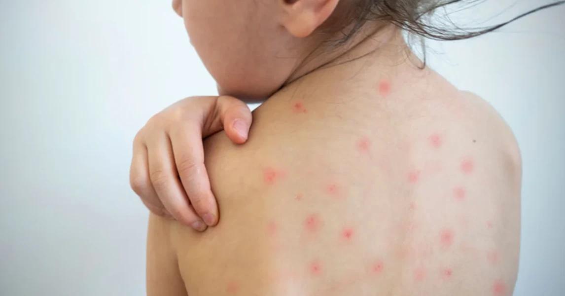 Crisis de salud pública en Argentina: la vacunación infantil contra sarampión y coqueluche cae al 50%