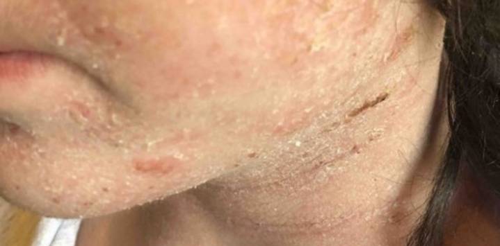 ¿Es bueno el jabón de leche de cabra para el eczema? Estos son los beneficios