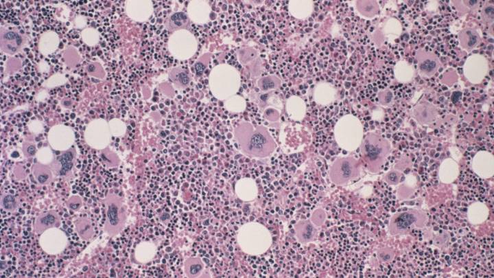 Incyte trial results at ASH: New approach to treating myelofibrosis