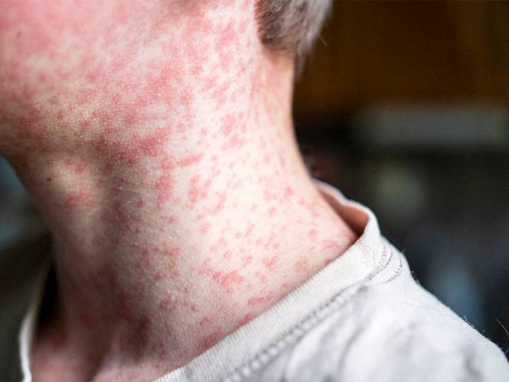 Recent measles exposure at Calgary airport, Claresholm hospital: AHS