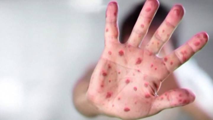 First measles case since 2021 under investigation in Connecticut