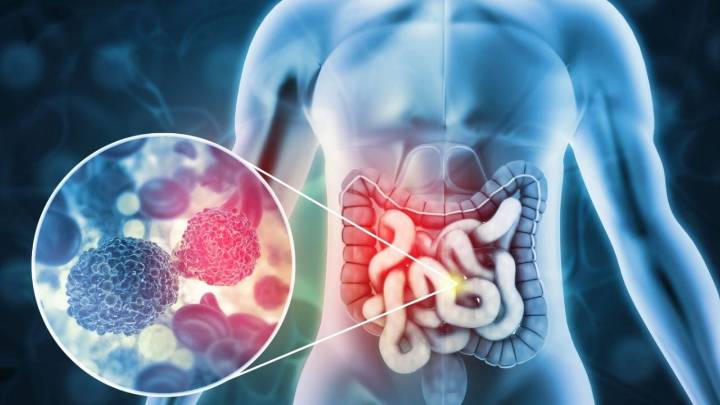 Así puedes detectar el cáncer de colon antes de que sea demasiado tarde