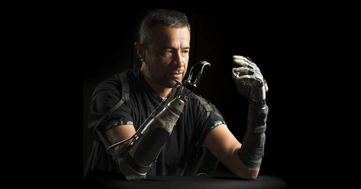 Amputees often feel disconnected from their bionic hands. AI could bridge the gap