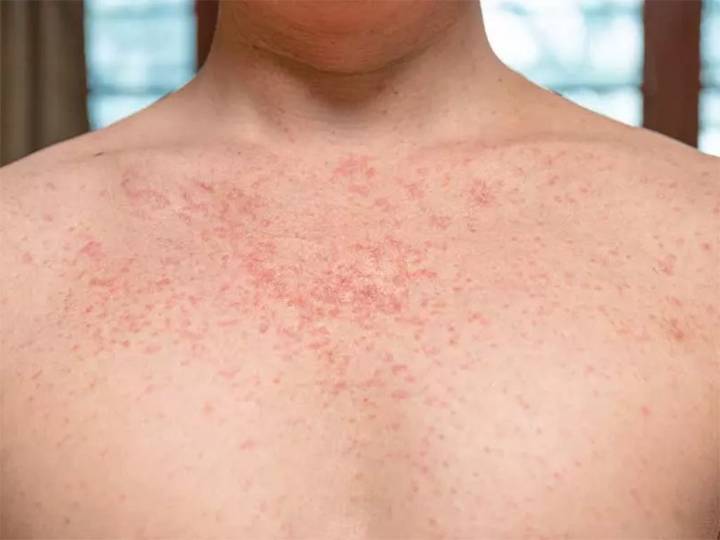 Confirman sexto caso de sarampión en Uruguay