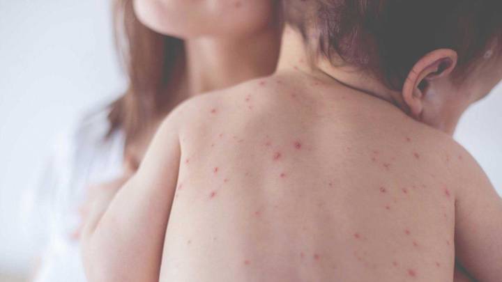 Alerta sanitaria por Sarampión: cuáles son sus síntomas y cómo prevenirlo